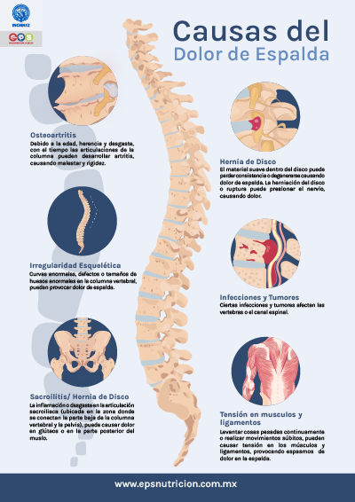 Causas del dolor de espalda