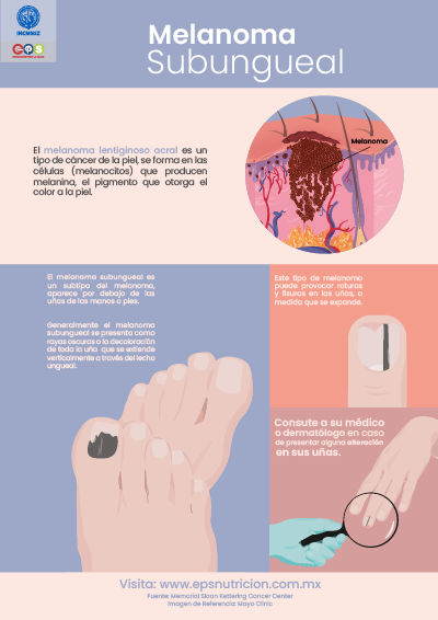 Melanoma subungeal
