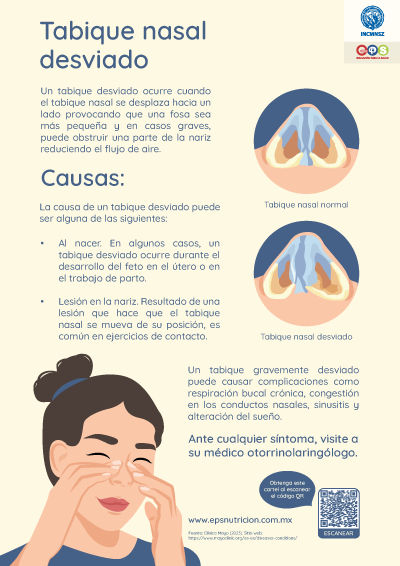 Tabique nasal desviado